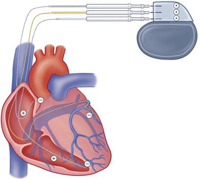 Hart en verschillende typen ICD's